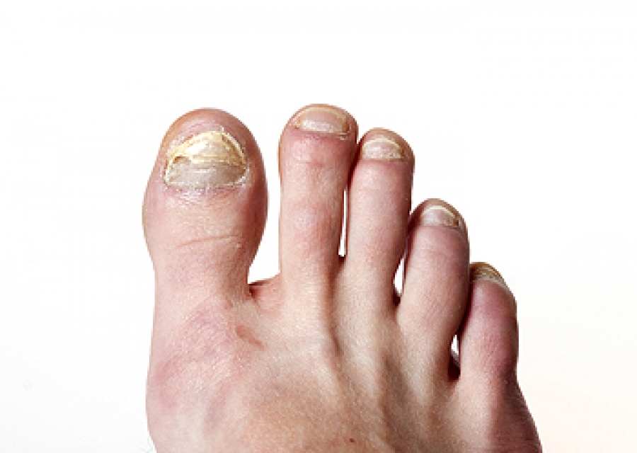 Is There A Link Between Obesity And Toenail Fungus